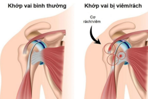 Khái niệm về bệnh viêm quanh khớp vai