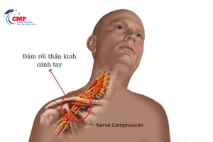 Xoa bóp bấm huyệt điều trị đám rối dây thần kinh